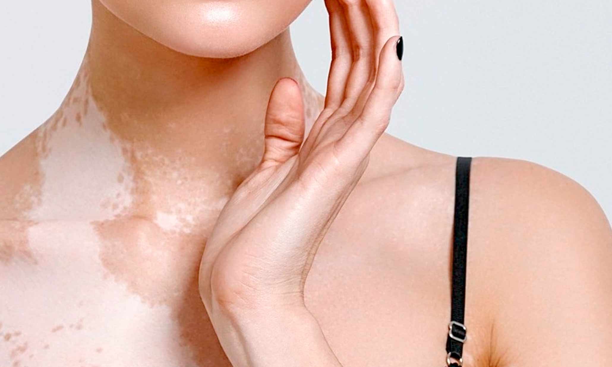 Loción para el tratamiento del vitiligo