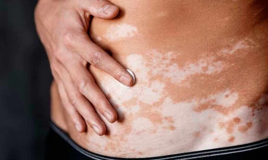 que es el vitiligo