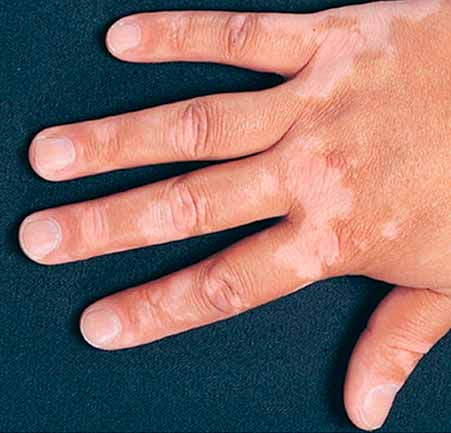 sintomas-del-vitiligo-mexico
