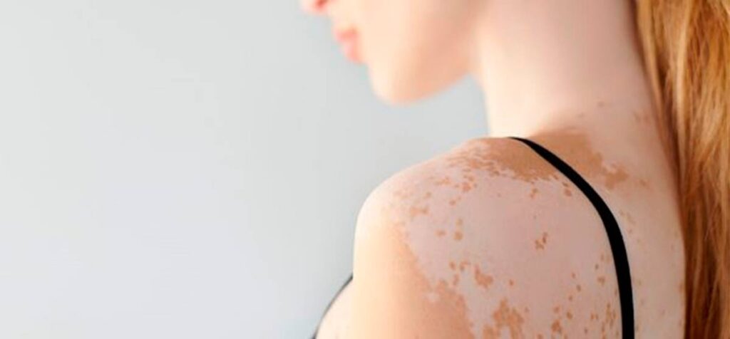 vitiligo---manchas-en-la-piel---melagenina-plus-mexico