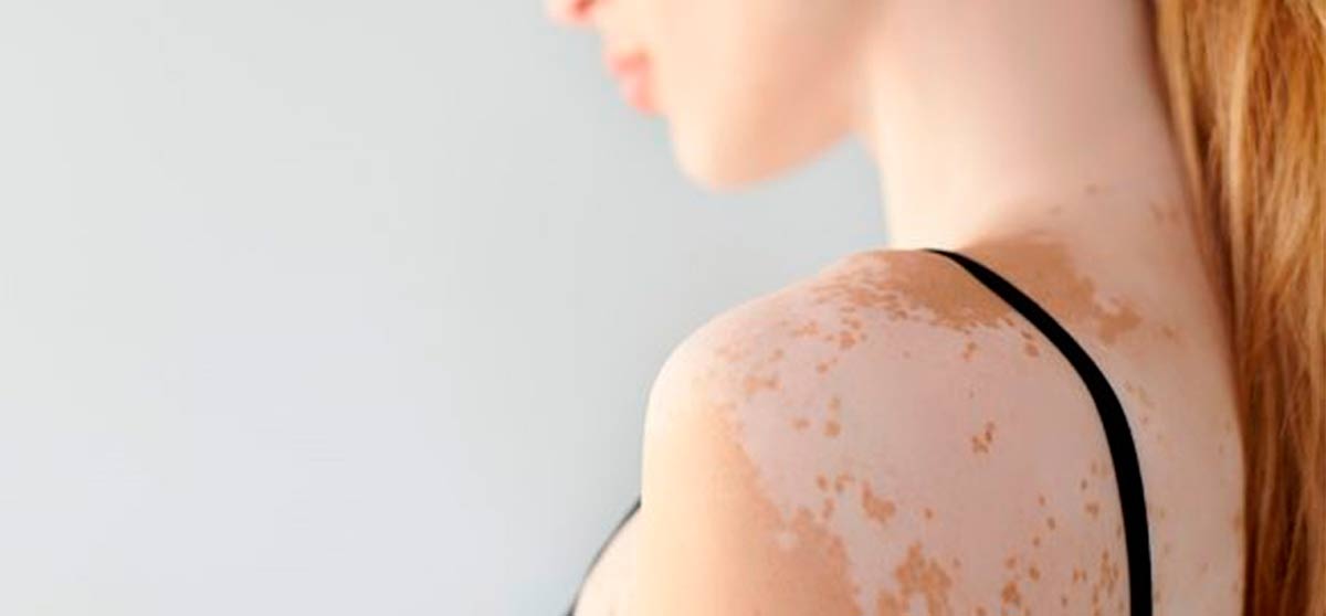 ¿MANCHAS BLANCAS EN LA PIEL? CUIDADO, PODRÍA SER VITILIGO