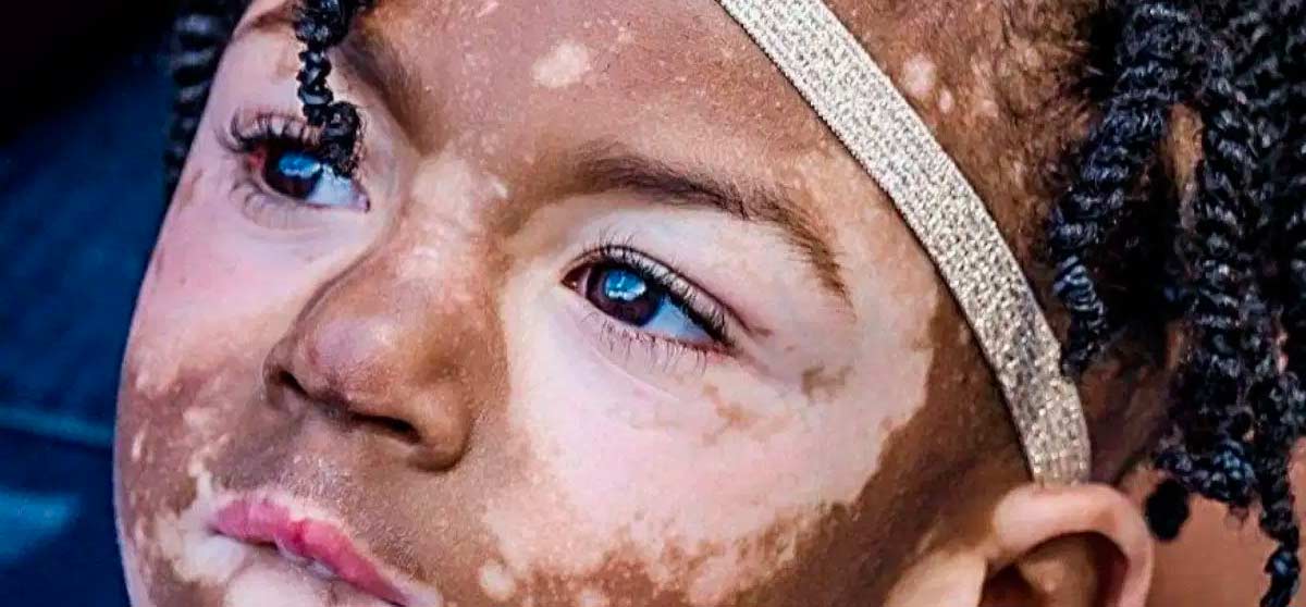 ¿QUÉ ES VITILIGO EN BEBÉS O NIÑOS? ¡DETECTALO A TIEMPO!