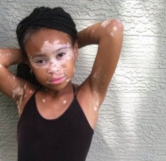 Vitiligo melagenina plus