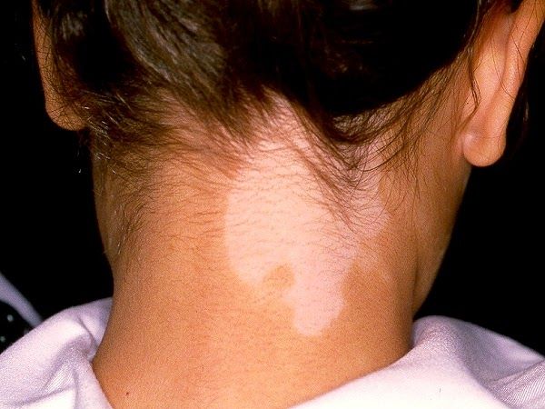 detectar vitiligo en niños