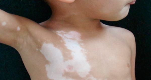 vitiligo-ninos